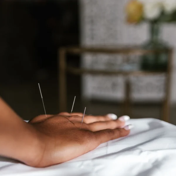 Acupuncture Traditional Treatment